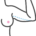 felkarplasztika